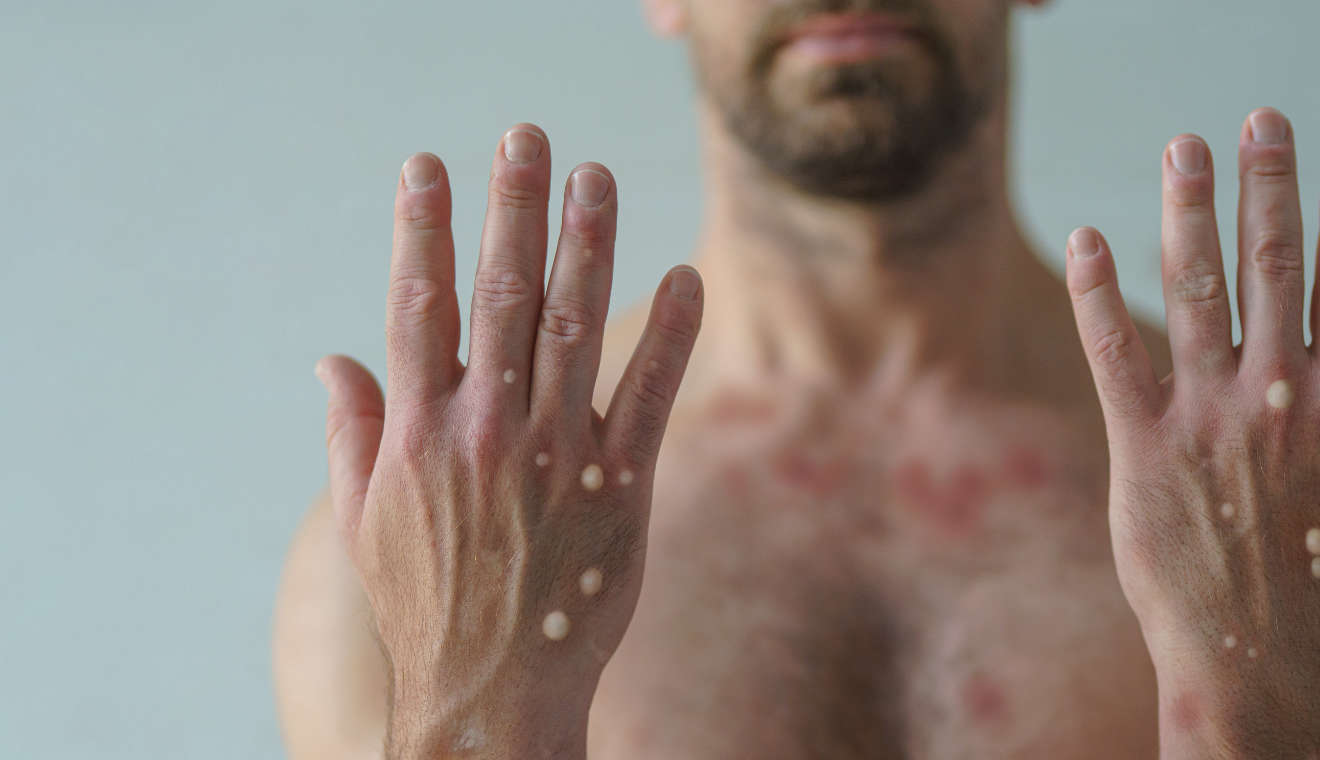 Gay community calls for monkeypox vaccines to be available in Switzerland -  WRS