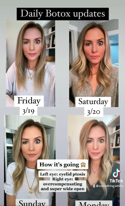 Watch Influencer Shares Reality Of Botox Gone Wrong Limericks Live 95 